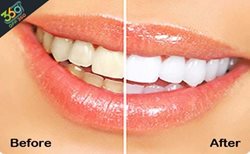 دندان هایی سفید و زیبا با جرم گیری در کلینیک دندانپزشکی لبخند زیبا