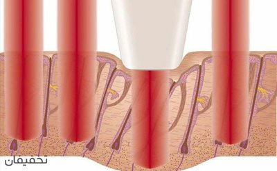 تهران-95-تخفیف-لیزر-موهای-زائد-دایود-2017-در-مطب-شارلوت-به-مدت-محدود-81740