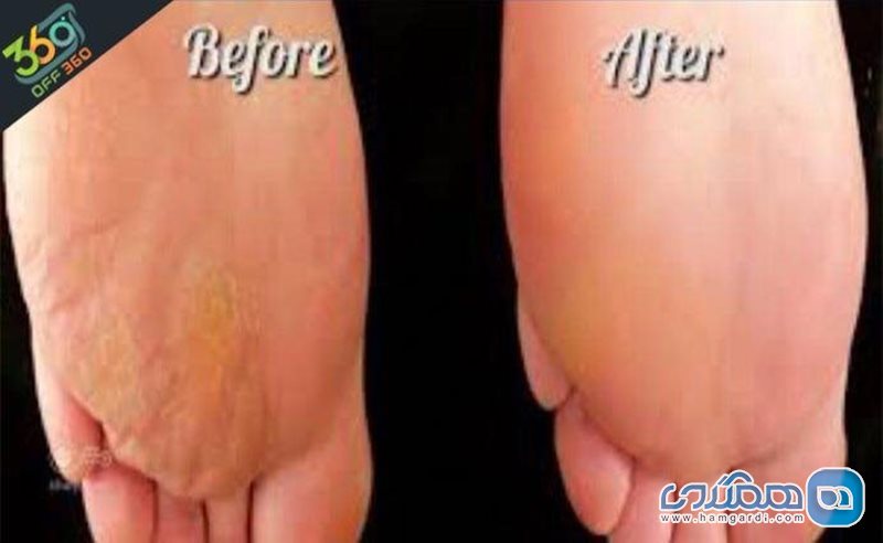 درمان انواع دردها و نرمی و لطافت پوست دست و پا با استفاده از پارافین تراپی