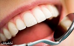 90% تخفیف یک جلسه جرم گیری دندان در دندانپزشکی لبخند