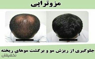 91% تخفیف جوانسازی و مزوتراپی سر و صورت در مطب دکتر خزعلی