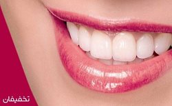 100% تخفیف  اصلاح طرح لبخند(کامپوزیت ونیر) در دندانپزشکی لبخند
