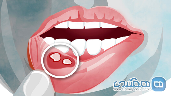 نشانه های مشکل دستگاه گوارش در دهان