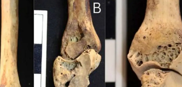 نگاهی به نتایج مطالعه روی استخوانهای اسکلت 3500 ساله یک زن